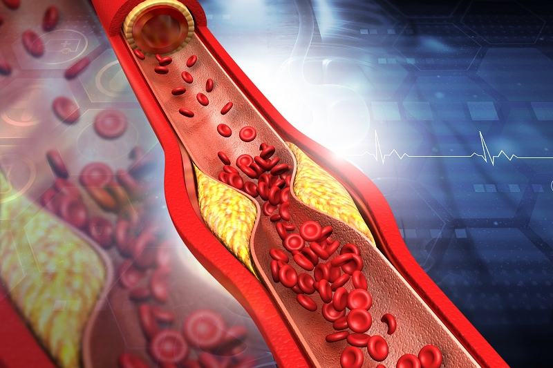 Clogged Arteries: 6 Nighttime Routines to Naturally Remove Plaque Formation