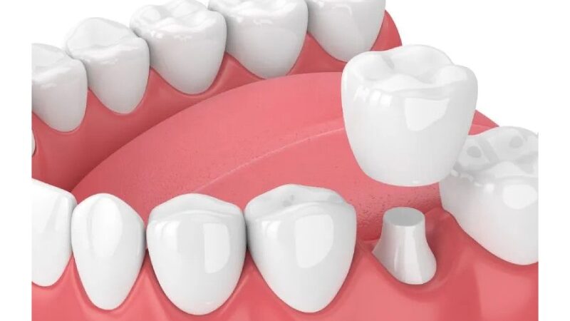 How to Prepare for Your Dental Crown Placement